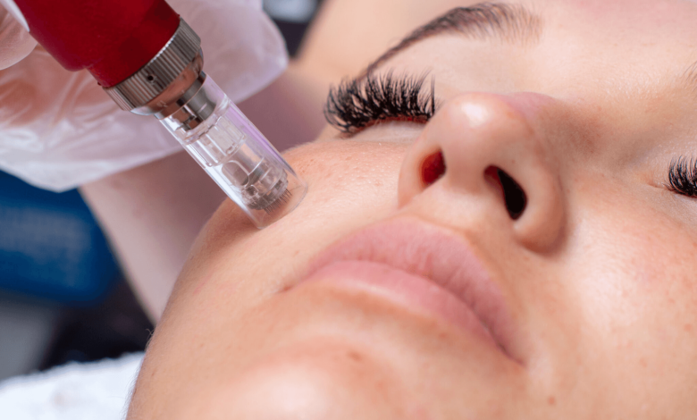 How Microneedling Treatment Can Improve Your Skin Texture and Tone Naturally