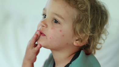 Bed Bug Bites on Babies: Signs and Safe Treatments