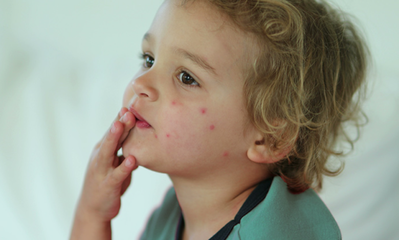 Bed Bug Bites on Babies: Signs and Safe Treatments